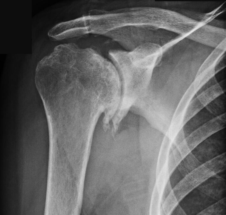 The X-ray showed shoulder arthrosis