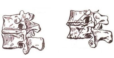 Stages of the development of cervical osteochondrosis