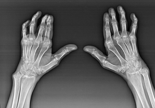 Diagnosis of fingers joints