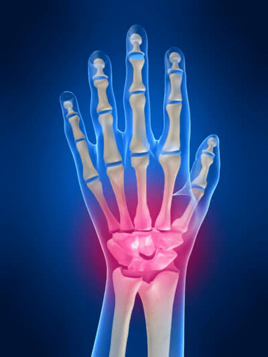 The joint inflammation of the wrist