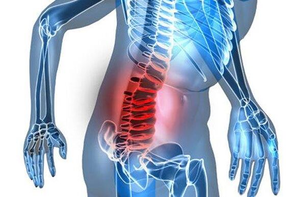 Deformity of the spine in the fourth stage of lumbar osteochondrosis