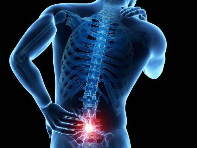 In the case of radiculitis, pinched nerve roots cause sharp pain in the lower back