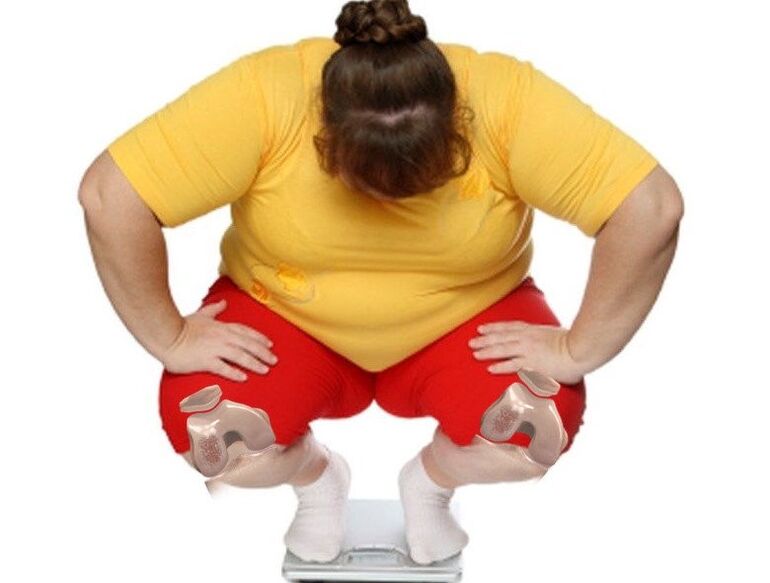 The majority of patients with arthrosis are overweight or obese