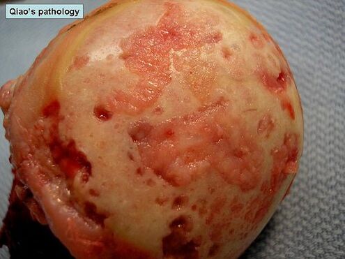 Cartilaginous surface affected by arthrosis