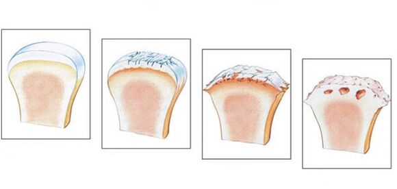 Healthy joint and 3 degrees of arthrosis development