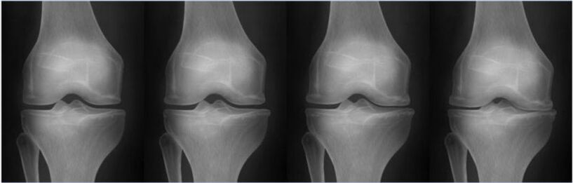 Stages of arthrosis according to the Kellgren-Lawrence classification