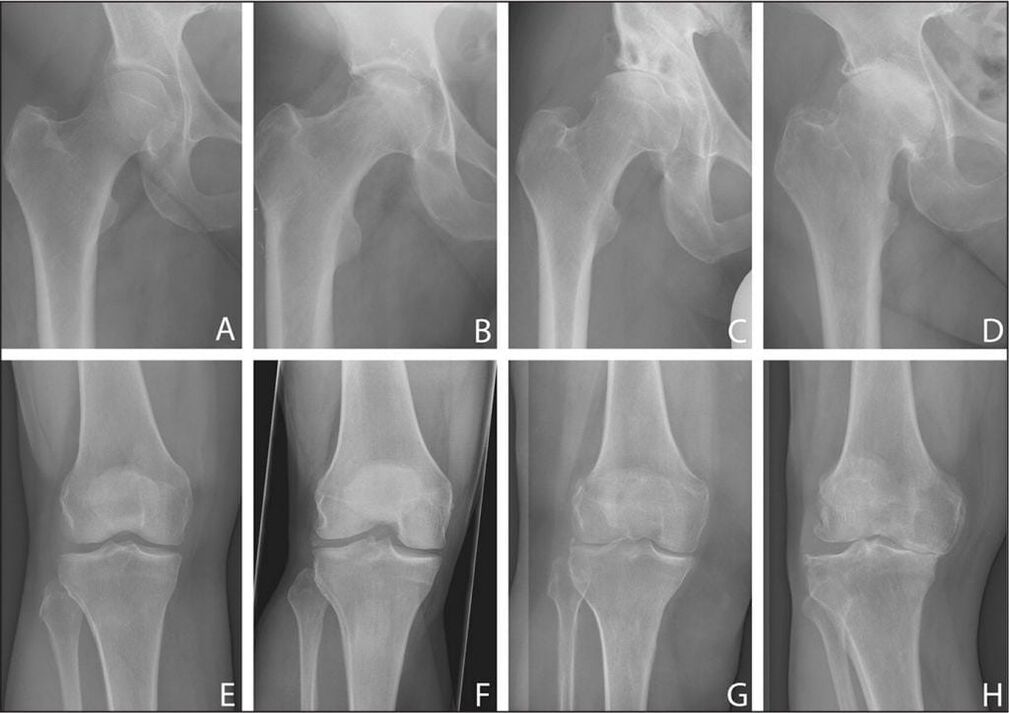 Stages of the development of joint arthrosis on X-ray